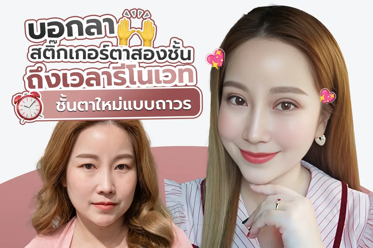 รีวิว บอกลาสติ๊กเกอร์ตาสองชั้นมา18ปี รีโนเวทตาสองชั้นใหม่แบบถาวร