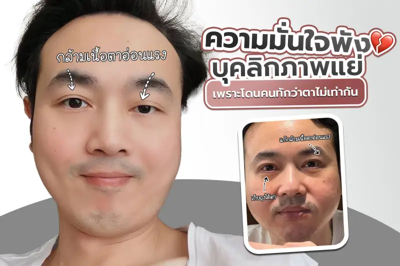 รีวิว ความมั่นใจพัง บุคลิกภาพแย่ เพราะโดนคนทักว่าตาไม่เท่ากัน