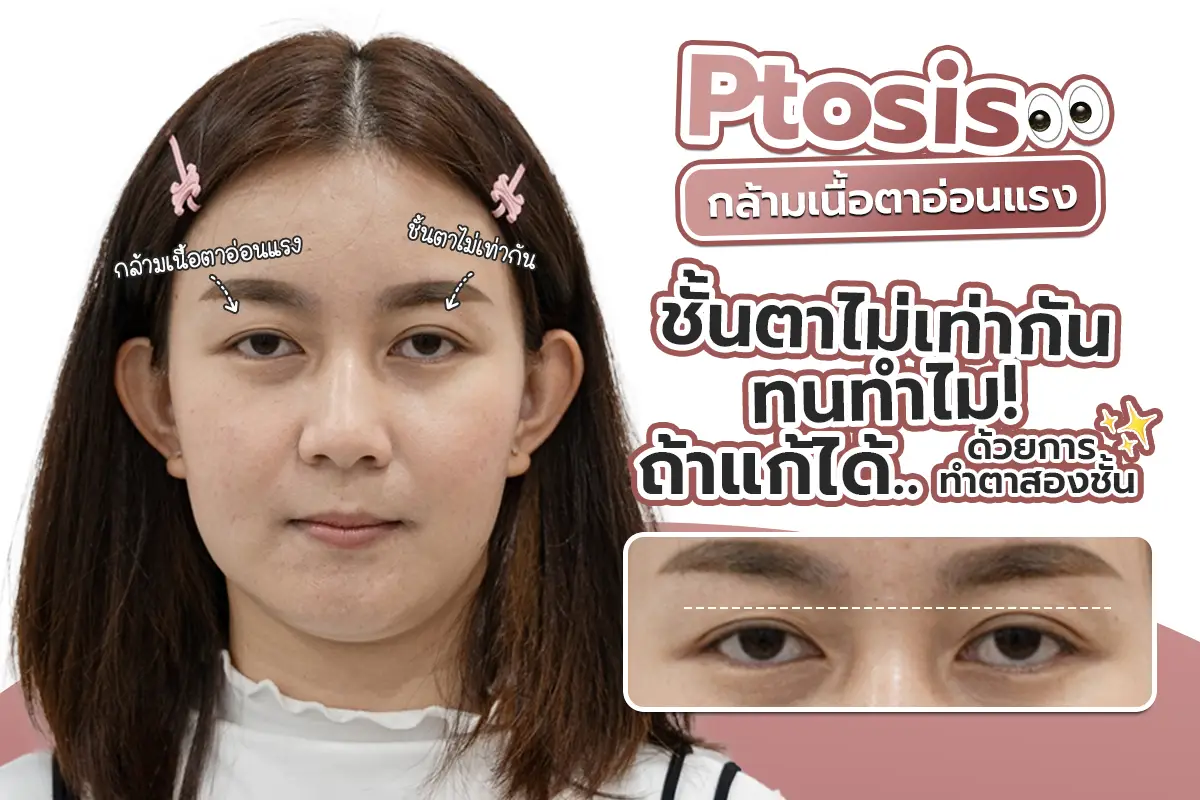 รีวิว Ptosis (กล้ามเนื้อตาอ่อนแรง) ชั้นตาไม่เท่ากัน ตาลอย ทนทำไมถ้าแก้ได้ด้วยการทำตาสองชั้น