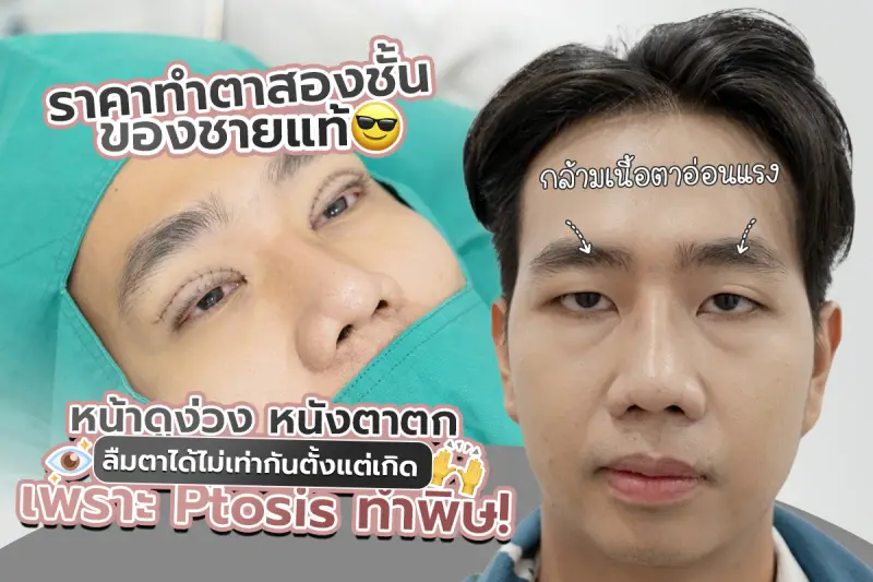 รีวิว ราคาทำตาสองชั้นของชายแท้ หน้าดูง่วง หนังตาตก ลืมตาได้ไม่เท่ากันตั้งแต่เกิด เพราะ Ptosis ทำพิษ
