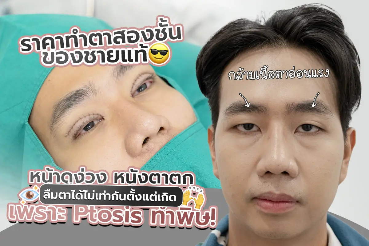 รีวิว ราคาทำตาสองชั้นของชายแท้ หน้าดูง่วง หนังตาตก ลืมตาได้ไม่เท่ากันตั้งแต่เกิด เพราะ Ptosis ทำพิษ