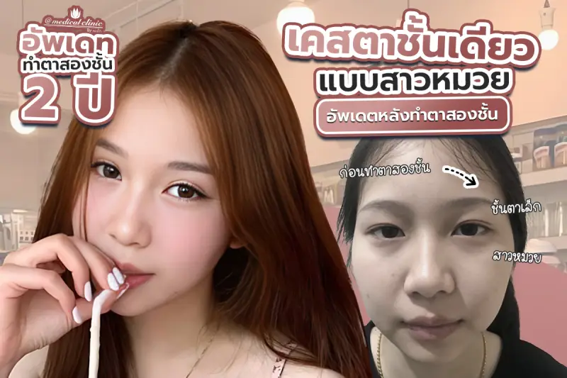 รีวิว รีวิวเคสตาชั้นเดียวแบบสาวหมวย