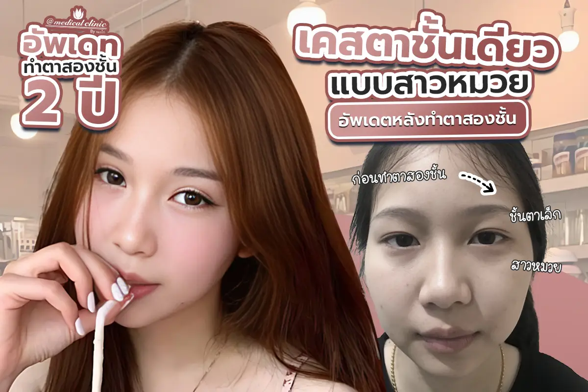 รีวิว รีวิวเคสตาชั้นเดียวแบบสาวหมวย