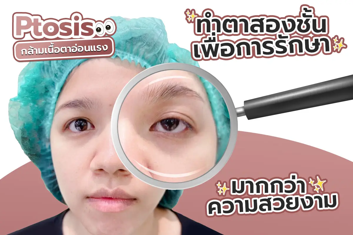รีวิว Ptosis ทำตาสองชั้นเพื่อการรักษา มากกว่าความสวยงาม