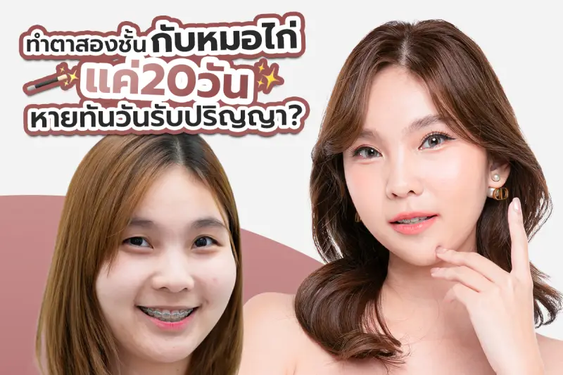 รีวิว ทำตาสองชั้นกับหมอไก่ แค่20วันหายทันวันรับปริญญา?