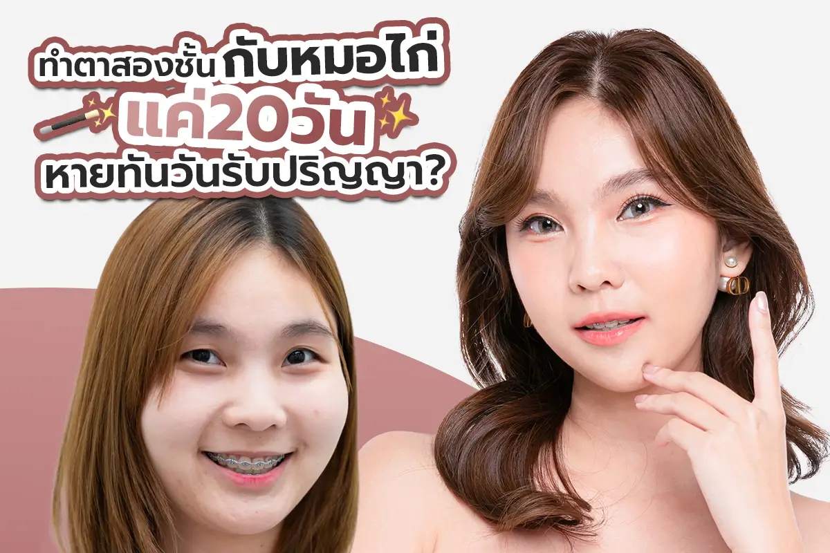 รีวิว ทำตาสองชั้นกับหมอไก่ แค่20วันหายทันวันรับปริญญา?