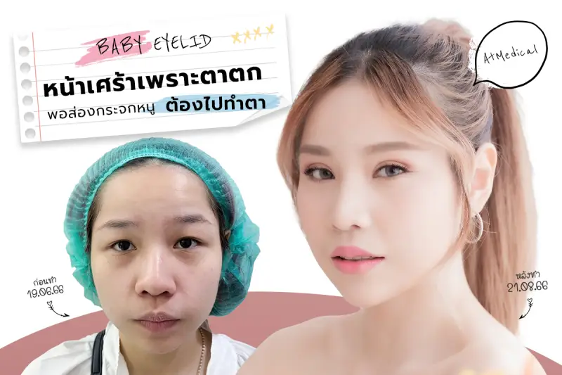 รีวิว หน้าเศร้าเพราะตาตก พอส่องกระจกหนูต้องไปทำตา