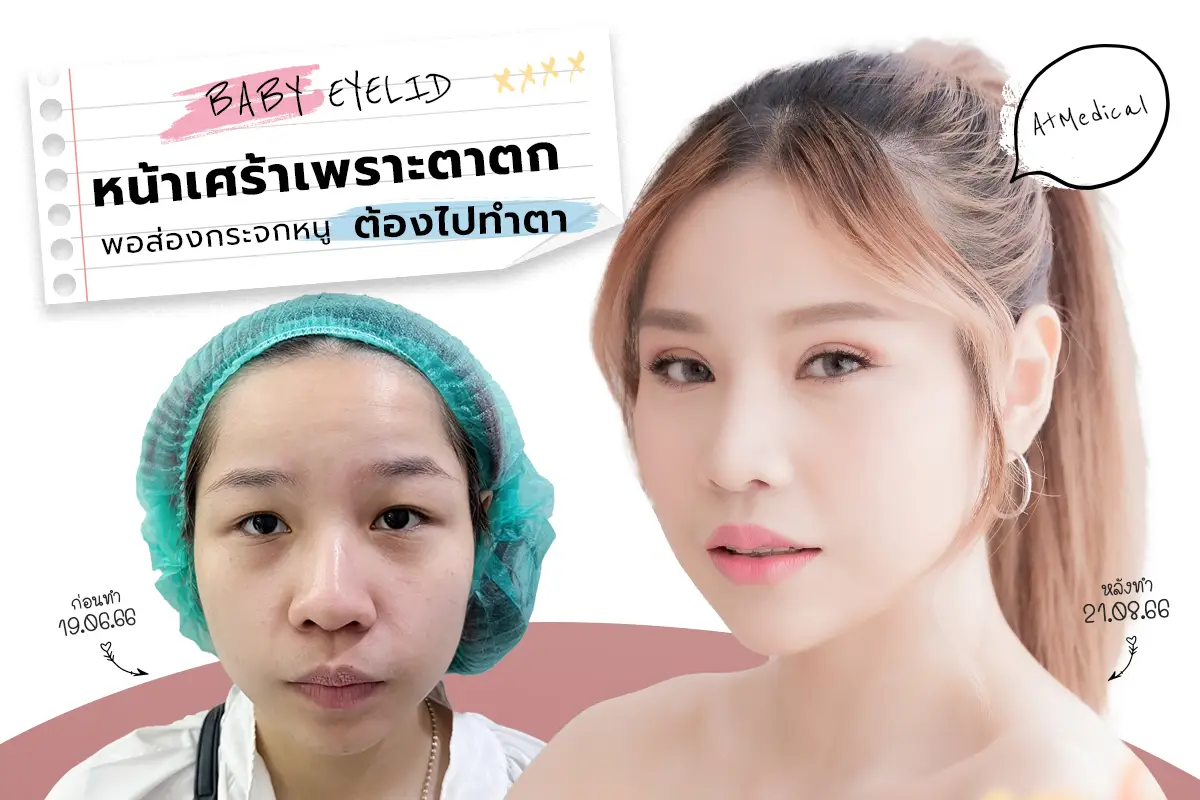 รีวิว หน้าเศร้าเพราะตาตก พอส่องกระจกหนูต้องไปทำตา