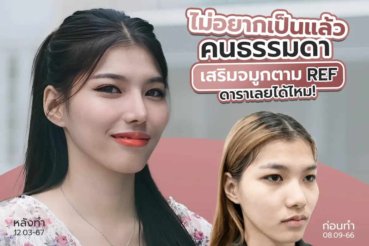 รีวิว ไม่อยากเป็นแล้วคนธรรมดา เสริมจมูกตามเรฟดาราเลยได้ไหม