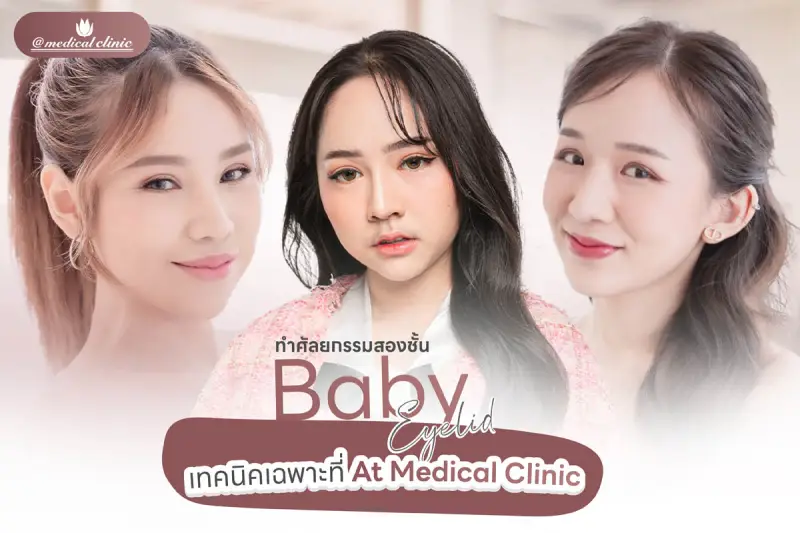 ศัลยกรรมตาสองชั้น Baby Eyelid
