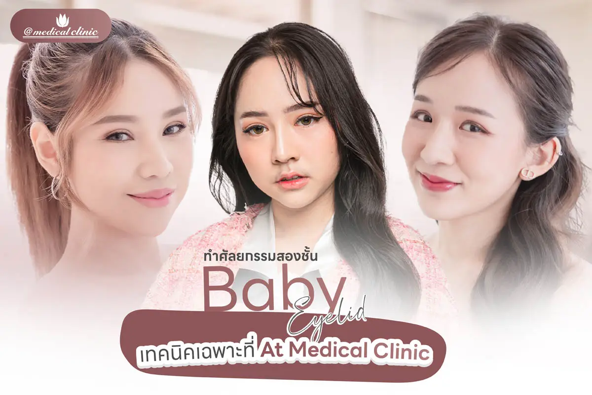 ศัลยกรรมตาสองชั้น Baby Eyelid