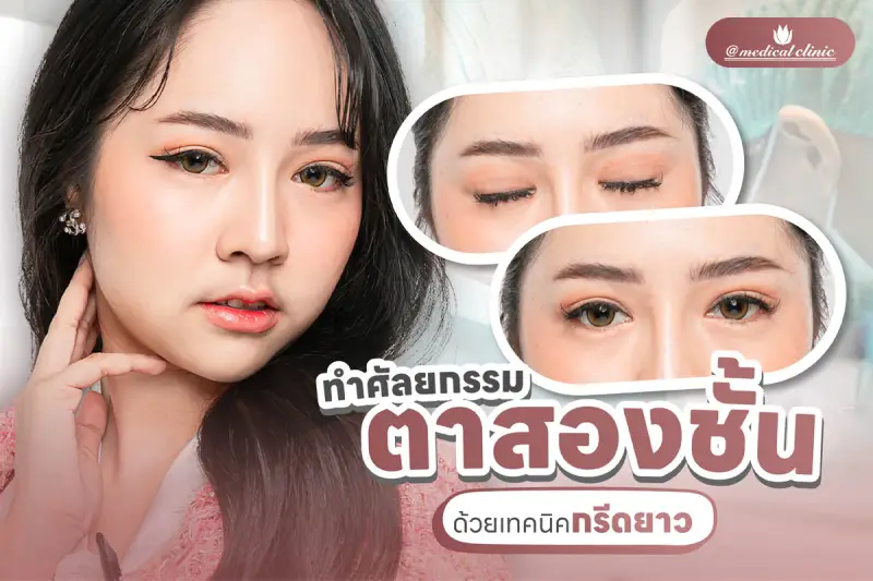 ศัลยกรรมตาสองชั้น กรีดยาว