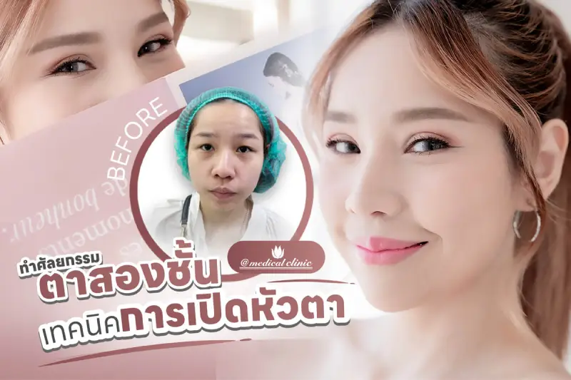 ศัลยกรรมตาสองชั้น เปิดหัวตา