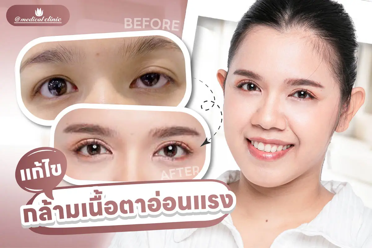 ศัลยกรรมตาสองชั้น แก้ไขกล้ามเนื้อตาอ่อนแรง