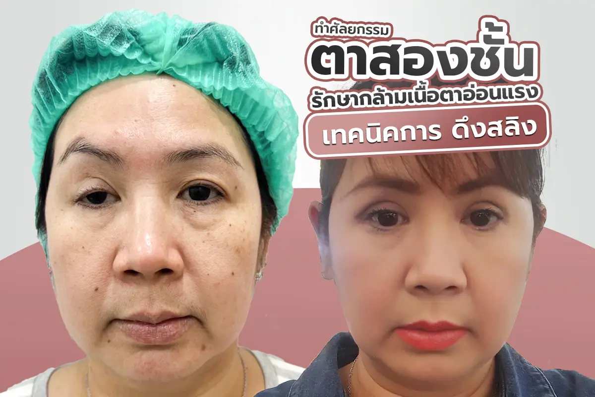 ศัลยกรรมตาสองชั้น เทคนิคดึงสลิง