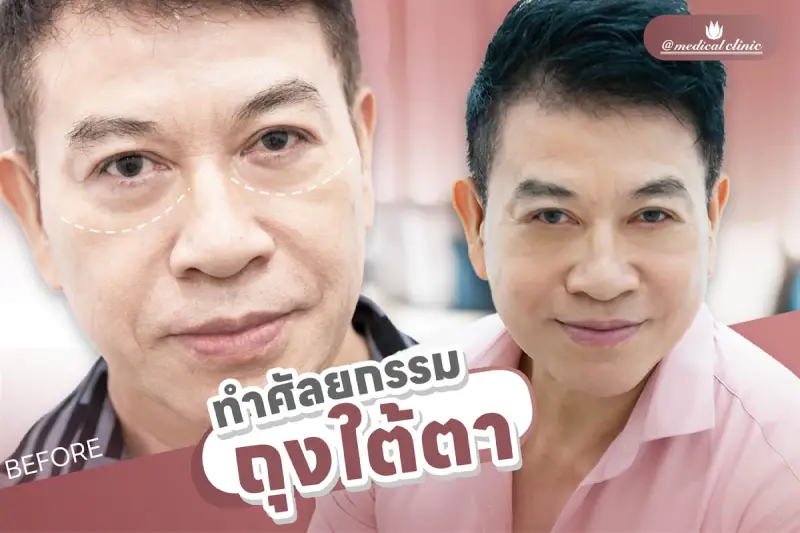 ศัลยกรรมตาสองชั้น ถุงใต้ตา