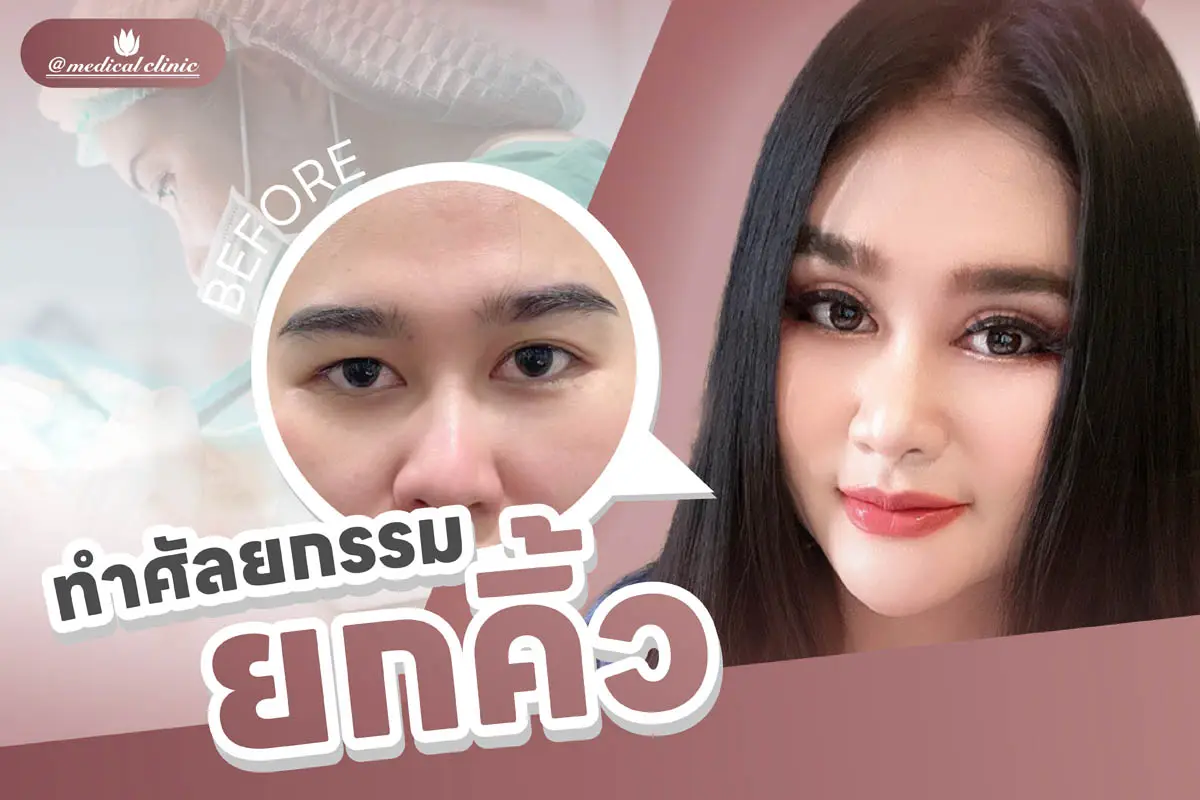 ศัลยกรรมตาสองชั้น ยกคิ้ว