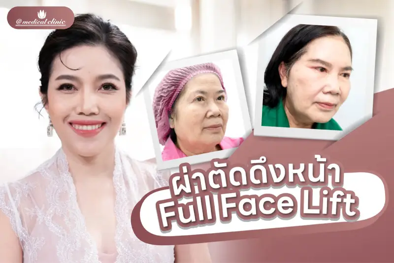 ศัลยกรรมดึงหน้า Full Face Lift