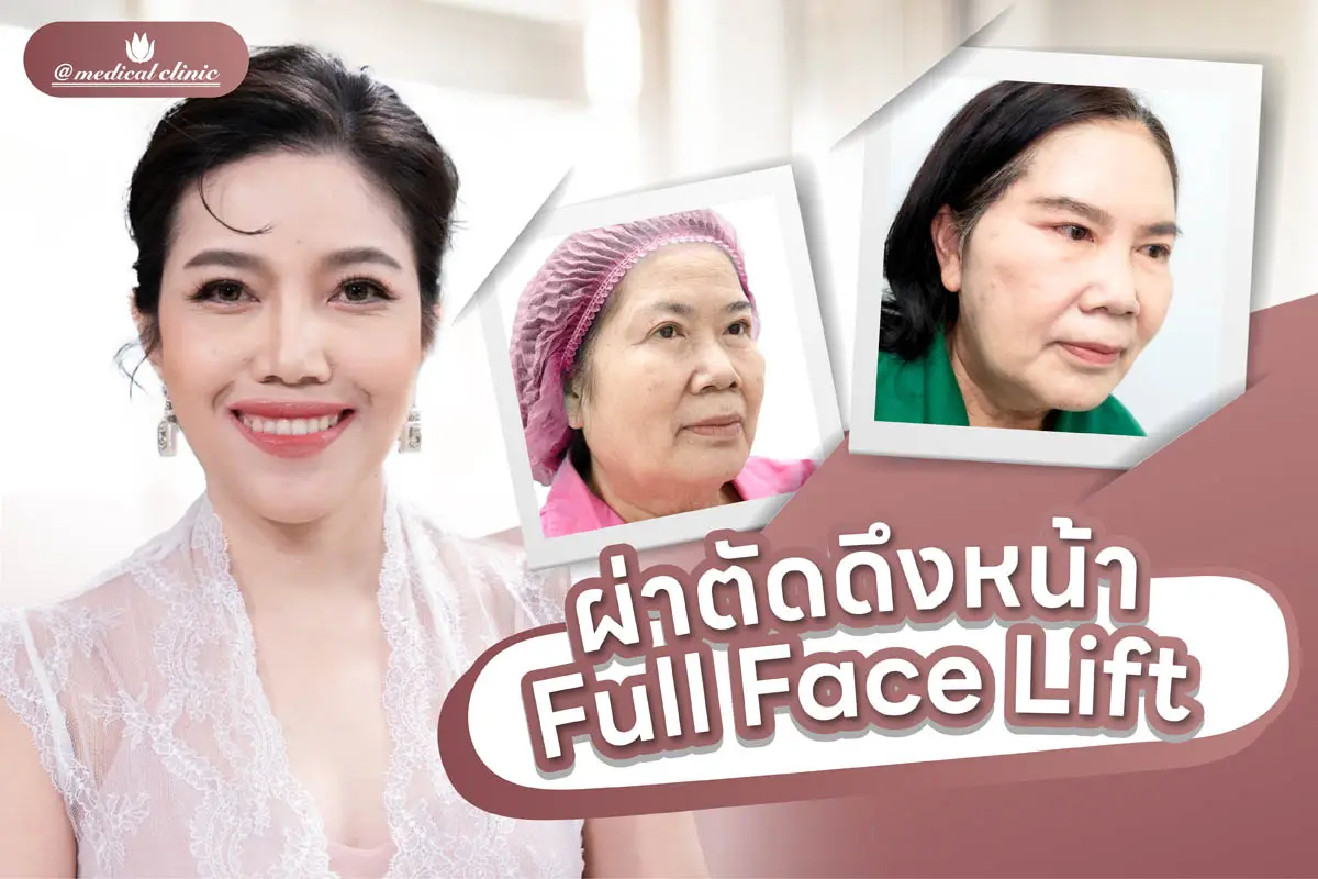ศัลยกรรมดึงหน้า Full Face Lift