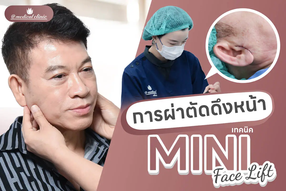 ศัลยกรรมดึงหน้า Mini Face Lift