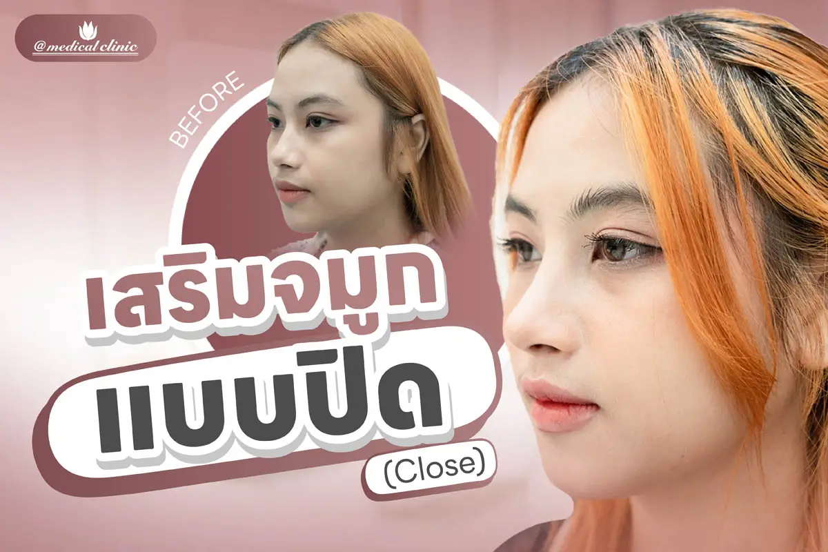 ศัลยกรรมเสริมจมูก Endonasal