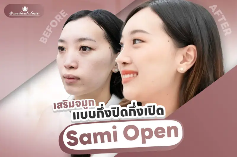 ศัลยกรรมเสริมจมูก Semi Open