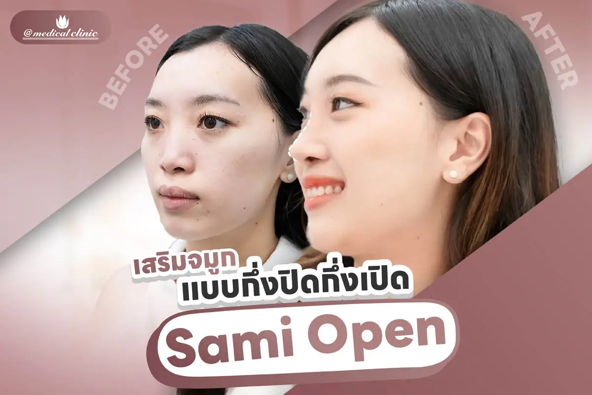 ศัลยกรรมเสริมจมูก Semi Open